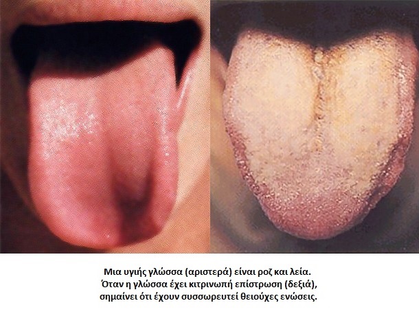 tongue_1_bad_breath.jpg