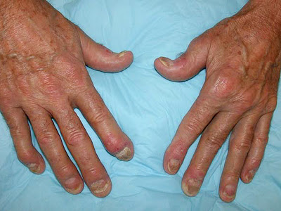 msr_140521_psoriatic_arthritis_800x600.jpg