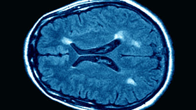 multiple_sclerosis,_mri_brain_scan