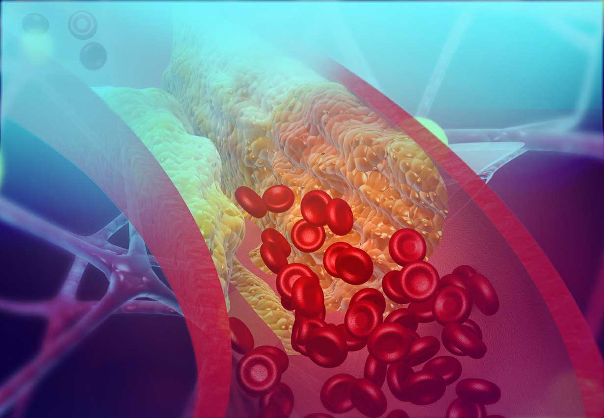 Cholesterol blocking artery. 3d illustration?
